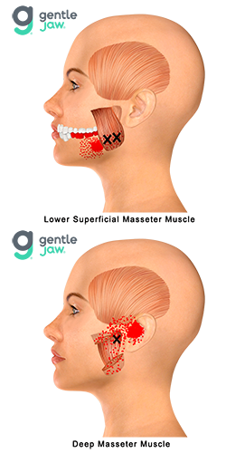 Muscle Referral Patterns Various Muscles.png